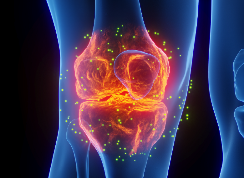 무릎 퇴행성 관절염